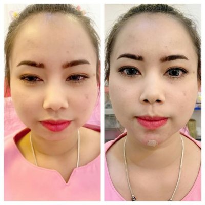 รูปผลการฉีดโบท็อก ฟิลเลอร์ ร้อยไหม
